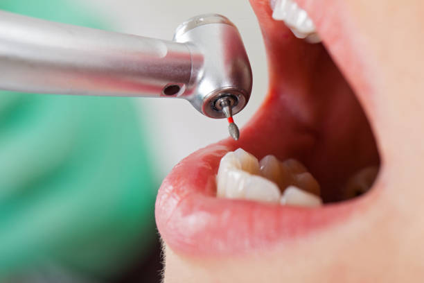 Best Emergency Root Canal Treatment in Lincolnshire, IL